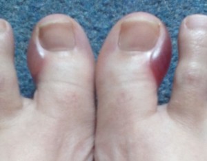 toe blisters 3rd chemo